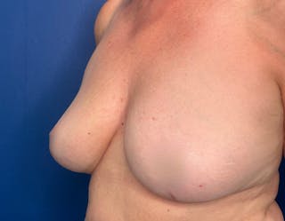 Breast Lift Before & After Gallery - Patient 215833 - Image 8