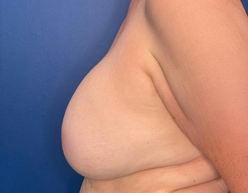 Breast Lift Before & After Gallery - Patient 215833 - Image 9