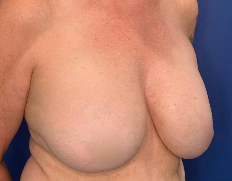 Breast Lift Before & After Gallery - Patient 215833 - Image 3