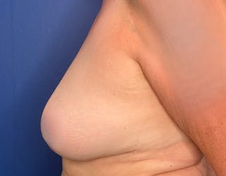 Breast Lift Before & After Gallery - Patient 215833 - Image 10