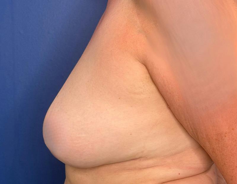 Breast Lift Before & After Gallery - Patient 215833 - Image 10