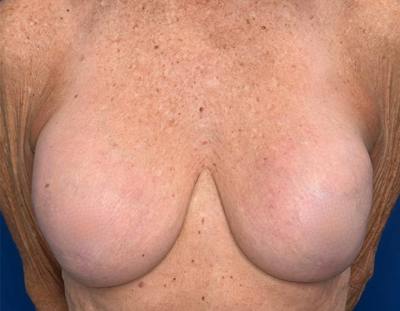 Breast Lift Before & After Gallery - Patient 862320 - Image 1