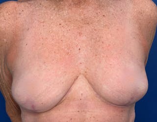 Breast Lift Before & After Gallery - Patient 862320 - Image 2