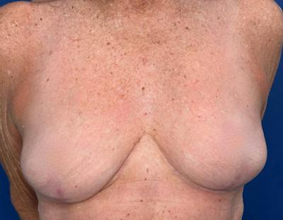 Breast Lift Before & After Gallery - Patient 862320 - Image 2