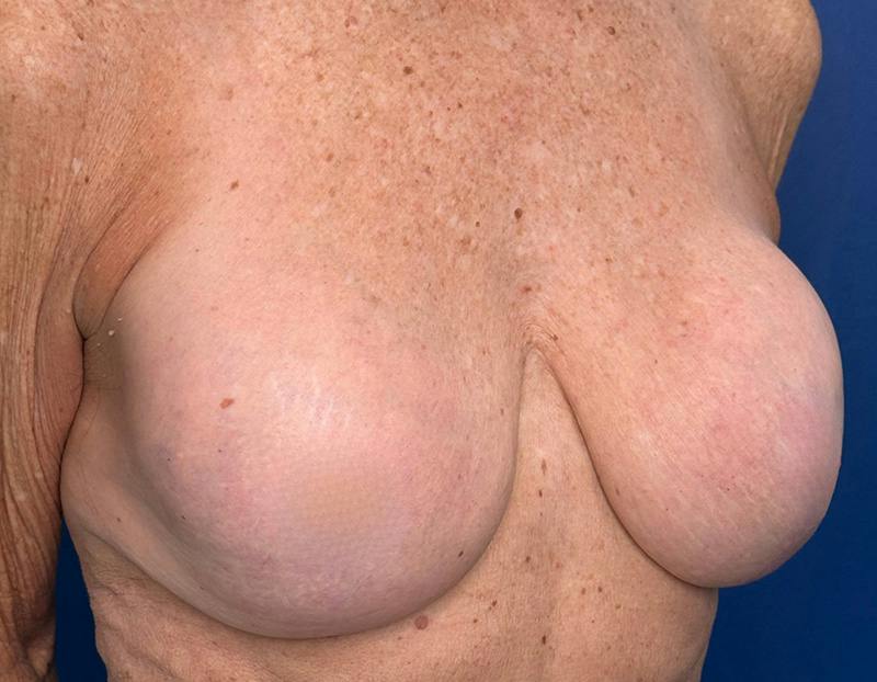 Breast Lift Before & After Gallery - Patient 862320 - Image 3