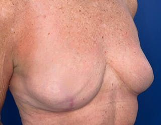Breast Lift Before & After Gallery - Patient 862320 - Image 4