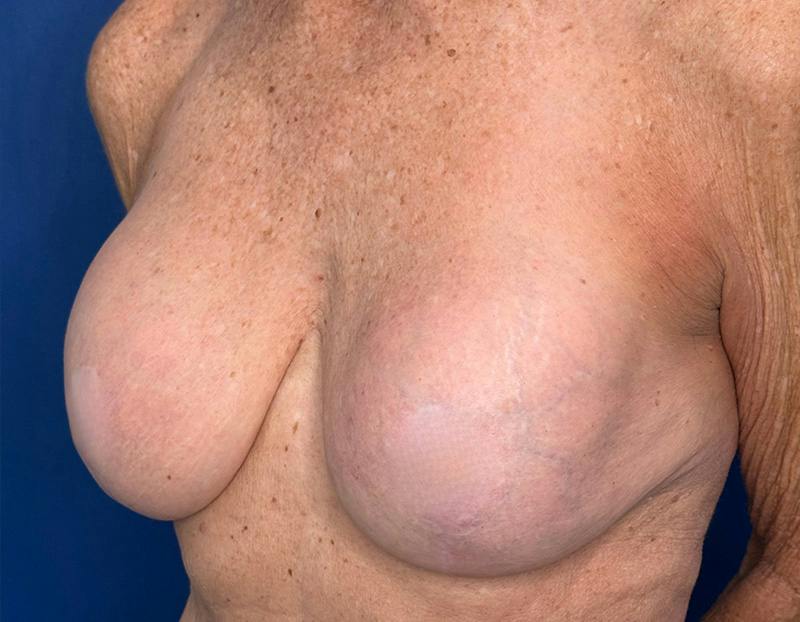Breast Lift Before & After Gallery - Patient 862320 - Image 7