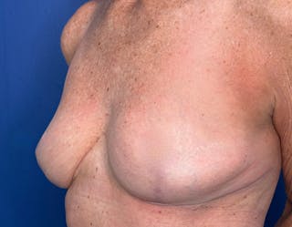 Breast Lift Before & After Gallery - Patient 862320 - Image 8