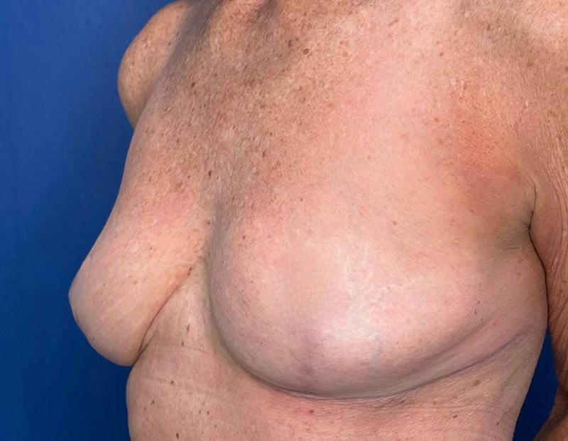 Breast Lift Before & After Gallery - Patient 862320 - Image 8