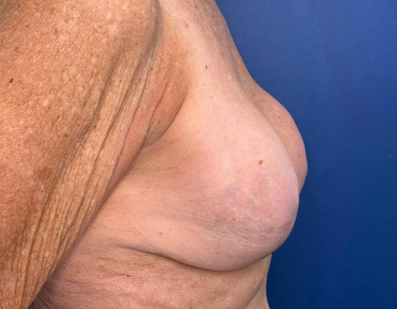 Breast Lift Before & After Gallery - Patient 862320 - Image 5