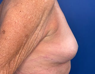 Breast Lift Before & After Gallery - Patient 862320 - Image 6