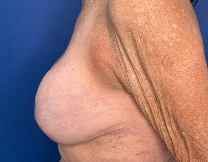 Breast Lift Before & After Gallery - Patient 862320 - Image 9