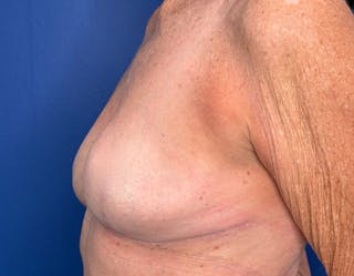Breast Lift Before & After Gallery - Patient 862320 - Image 10