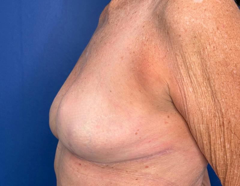 Breast Lift Before & After Gallery - Patient 862320 - Image 10