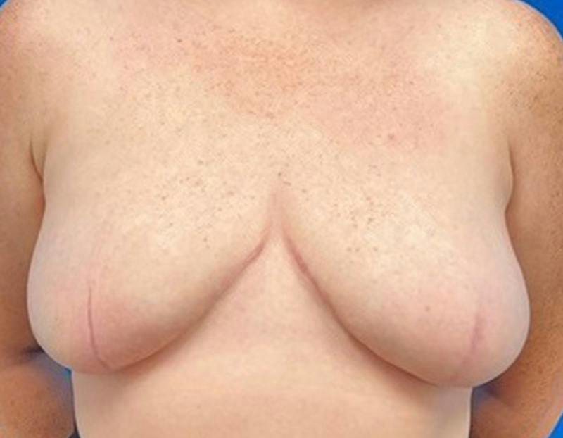 Breast Reduction Before & After Gallery - Patient 273273 - Image 2
