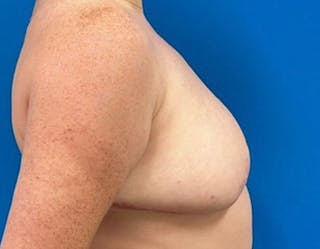Breast Reduction Before & After Gallery - Patient 273273 - Image 6