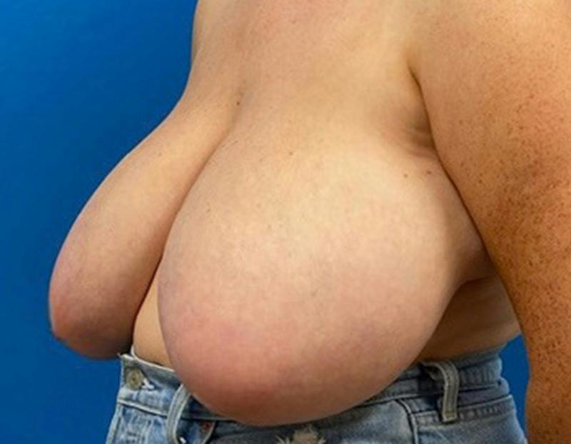 Breast Reduction Before & After Gallery - Patient 273273 - Image 7
