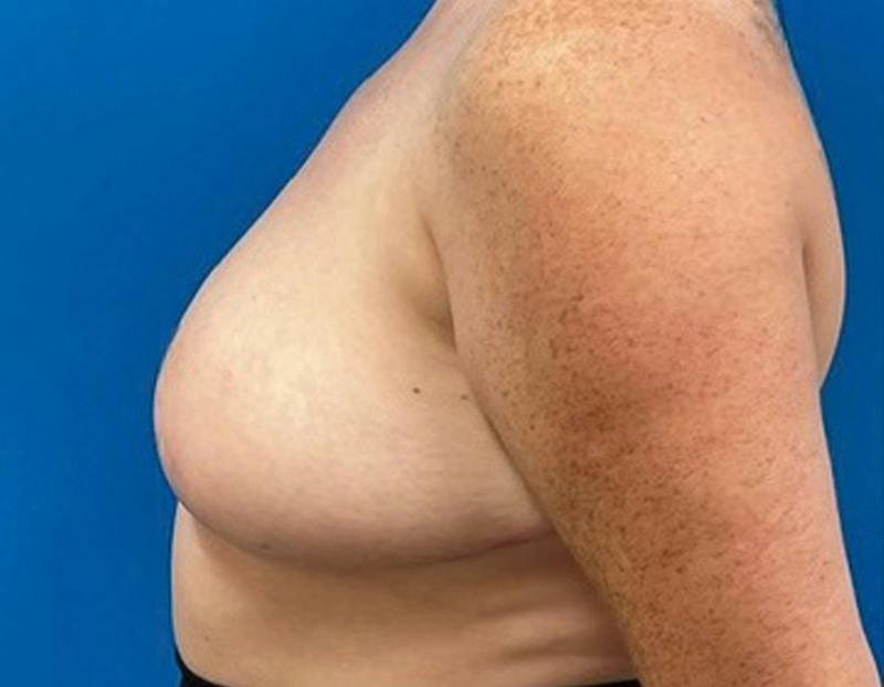 Breast Reduction Before & After Gallery - Patient 273273 - Image 10