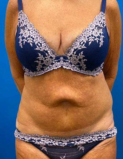 Tummy Tuck Before & After Gallery - Patient 190515 - Image 1