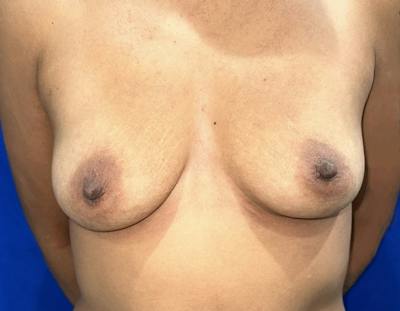 Breast Augmentation Before & After Gallery - Patient 387297 - Image 1