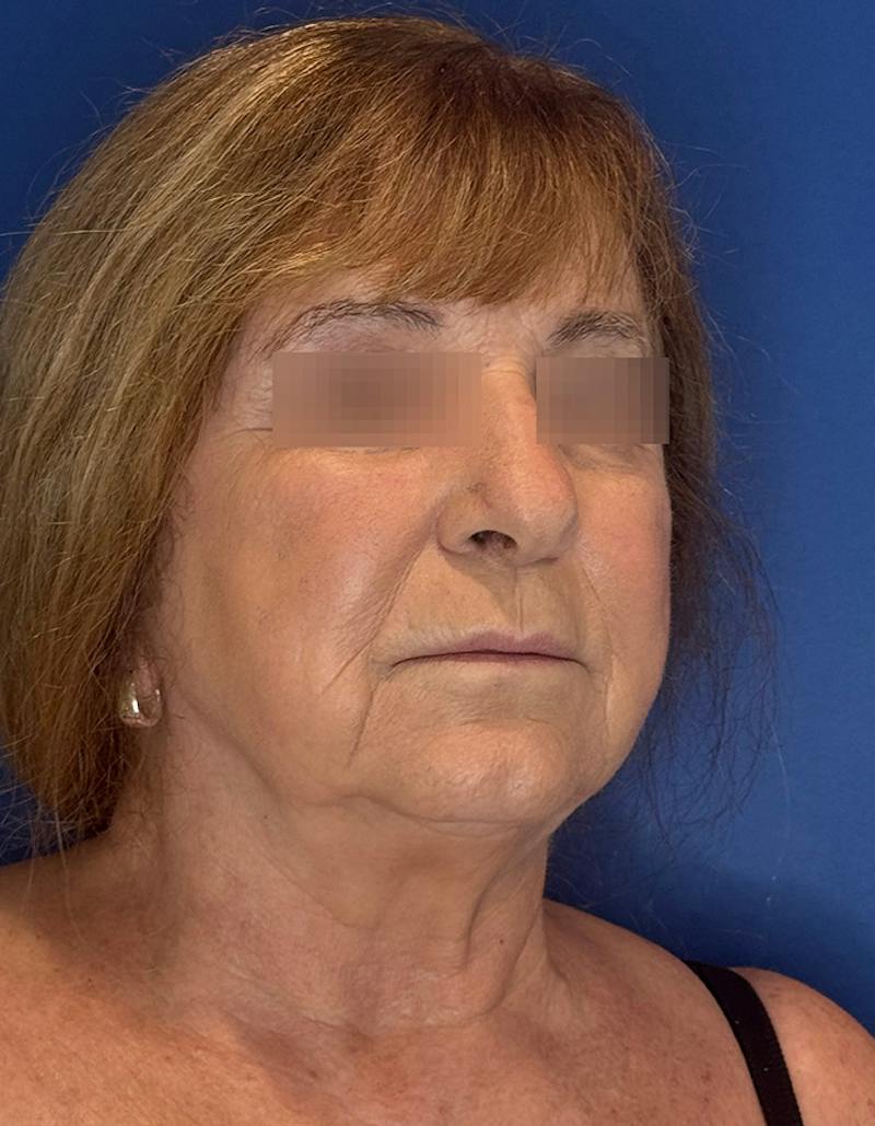 Face Lift Before & After Gallery - Patient 340457 - Image 3