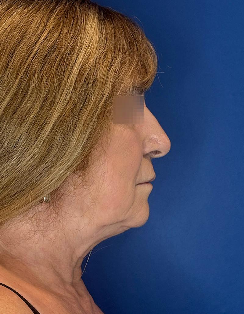 Face Lift Before & After Gallery - Patient 340457 - Image 5