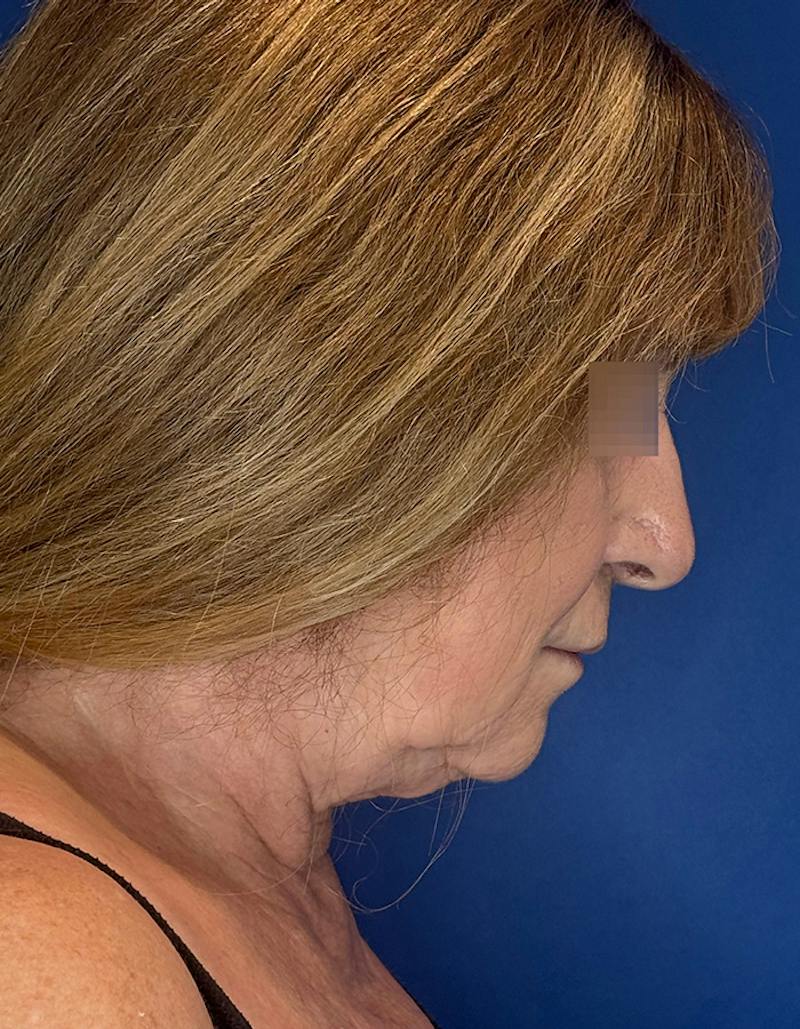 Face Lift Before & After Gallery - Patient 340457 - Image 7