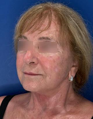 Face Lift Before & After Gallery - Patient 340457 - Image 10