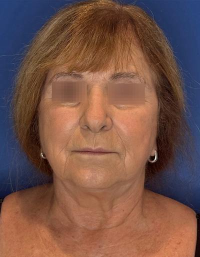 Face Lift Before & After Gallery - Patient 340457 - Image 1