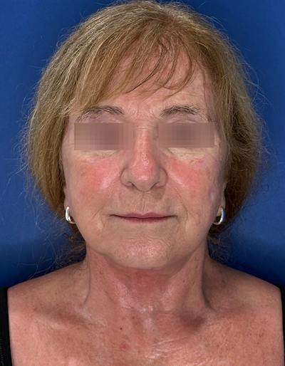 Face Lift Before & After Gallery - Patient 340457 - Image 2