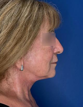 Face Lift Before & After Gallery - Patient 340457 - Image 6