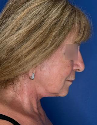Face Lift Before & After Gallery - Patient 340457 - Image 8