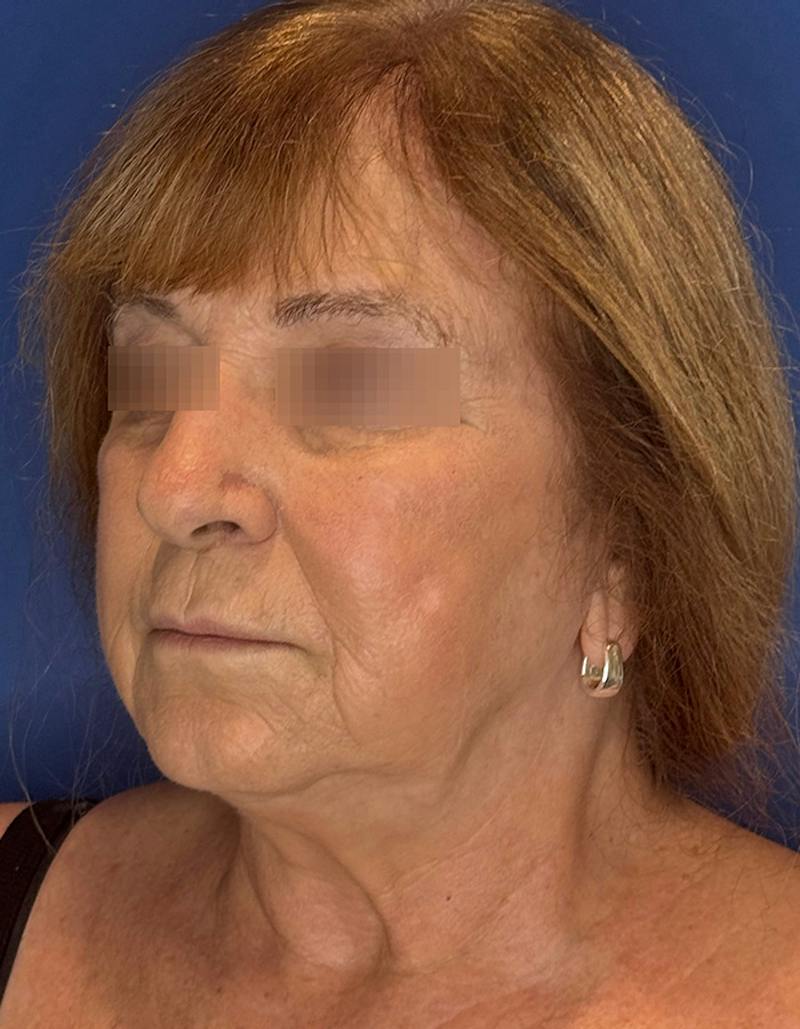 Face Lift Before & After Gallery - Patient 340457 - Image 9