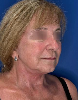 Face Lift Before & After Gallery - Patient 340457 - Image 4