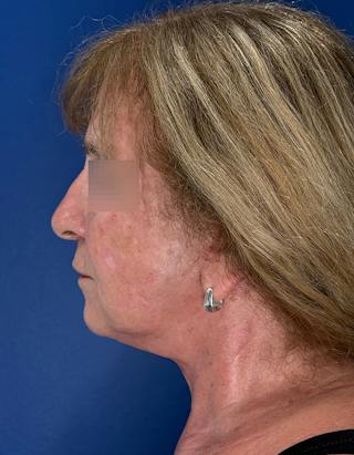 Face Lift Before & After Gallery - Patient 340457 - Image 12