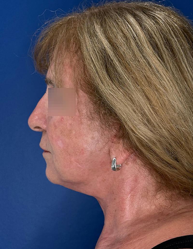 Face Lift Before & After Gallery - Patient 340457 - Image 12