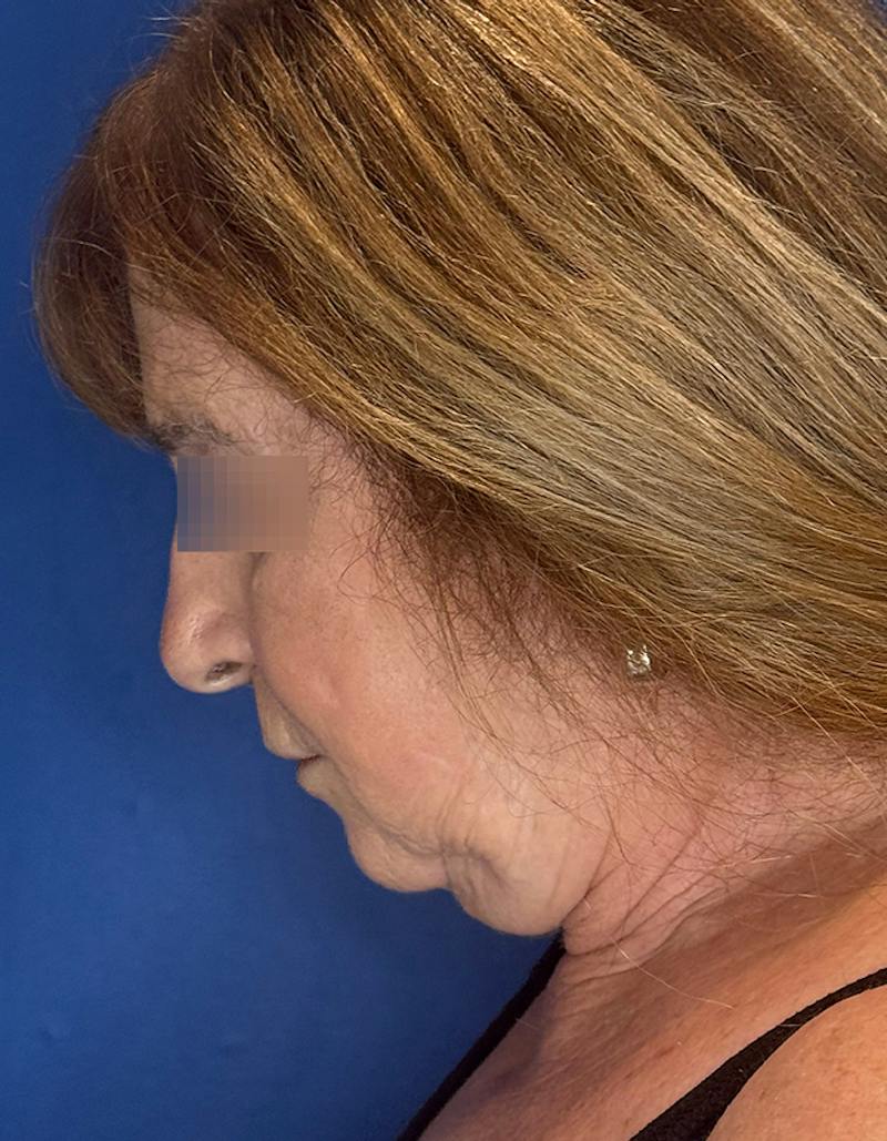 Face Lift Before & After Gallery - Patient 340457 - Image 13
