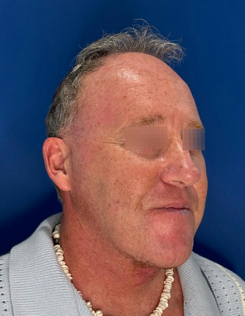 Face Lift Before & After Gallery - Patient 167892 - Image 4
