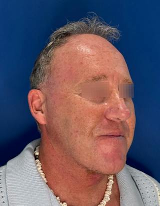 Face Lift Before & After Gallery - Patient 167892 - Image 4