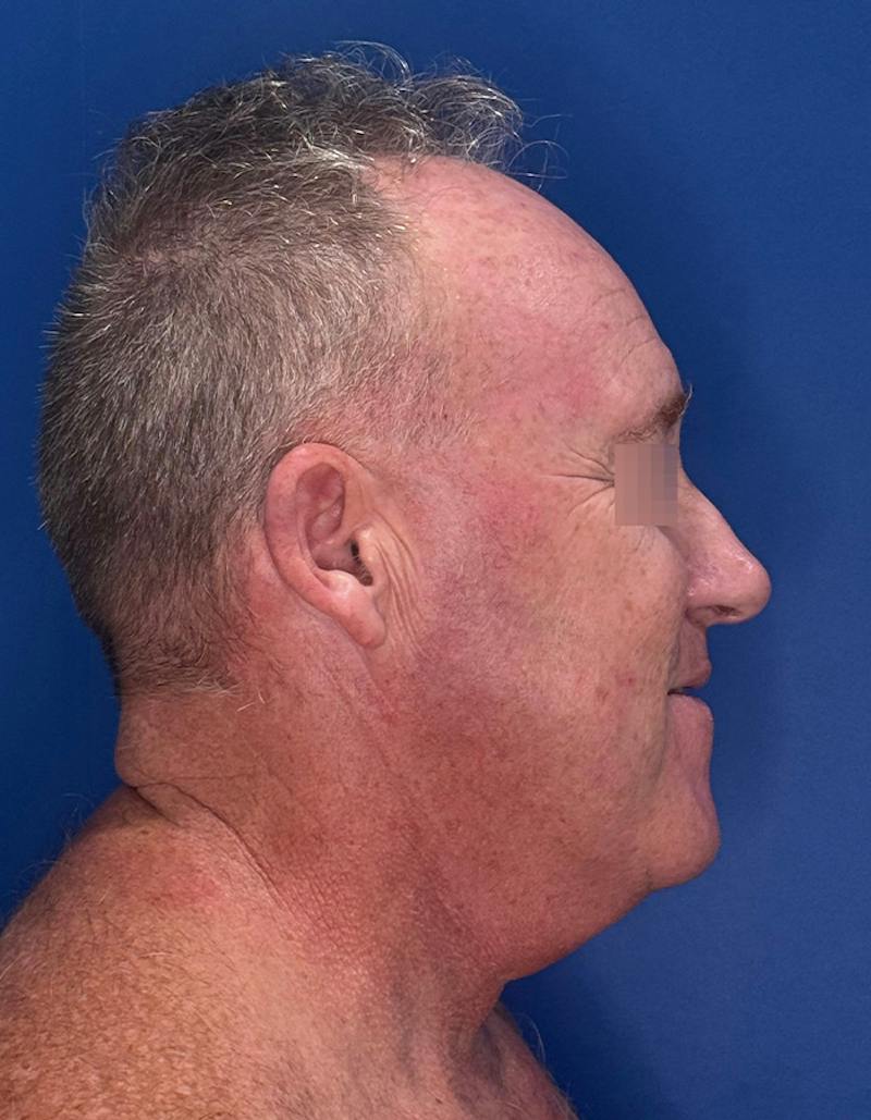 Face Lift Before & After Gallery - Patient 167892 - Image 5