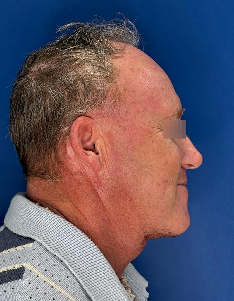 Face Lift Before & After Gallery - Patient 167892 - Image 6
