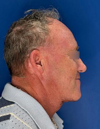 Face Lift Before & After Gallery - Patient 167892 - Image 6