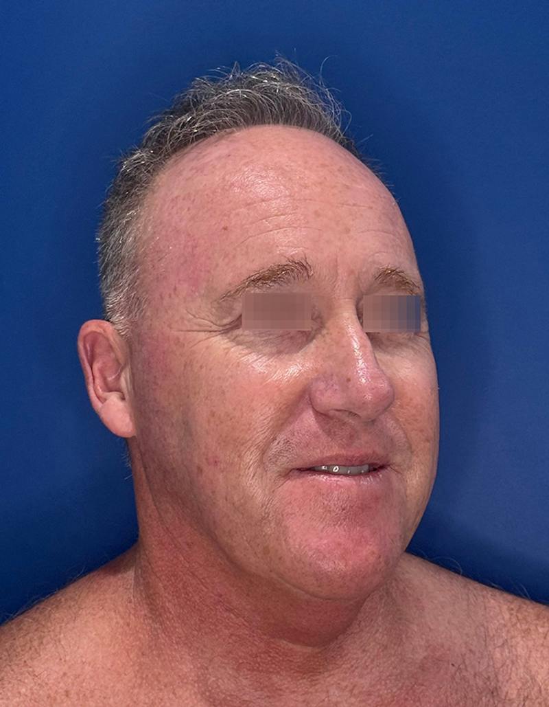 Face Lift Before & After Gallery - Patient 167892 - Image 3