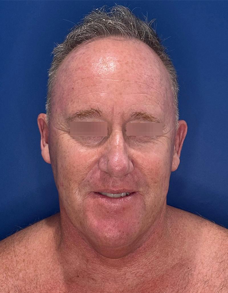 Face Lift Before & After Gallery - Patient 167892 - Image 1