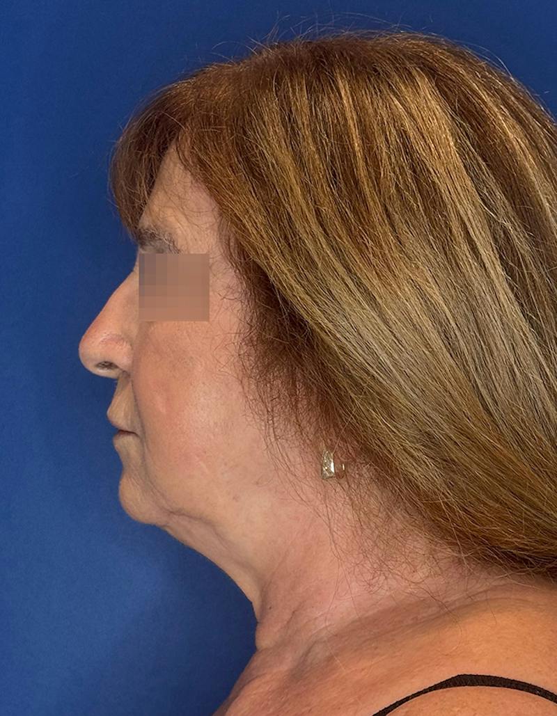 Face Lift Before & After Gallery - Patient 340457 - Image 11