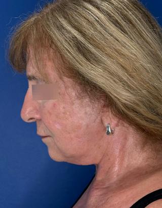 Face Lift Before & After Gallery - Patient 340457 - Image 14