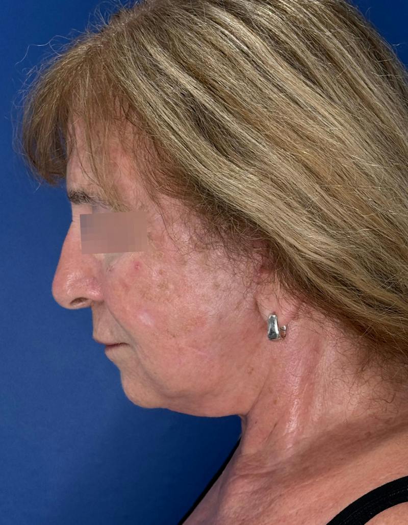 Face Lift Before & After Gallery - Patient 340457 - Image 14