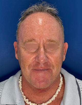 Face Lift Before & After Gallery - Patient 167892 - Image 2