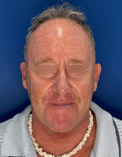 Face Lift Before & After Gallery - Patient 167892 - Image 2