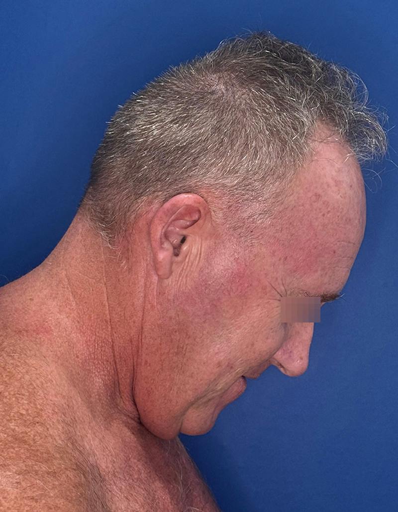 Face Lift Before & After Gallery - Patient 167892 - Image 7
